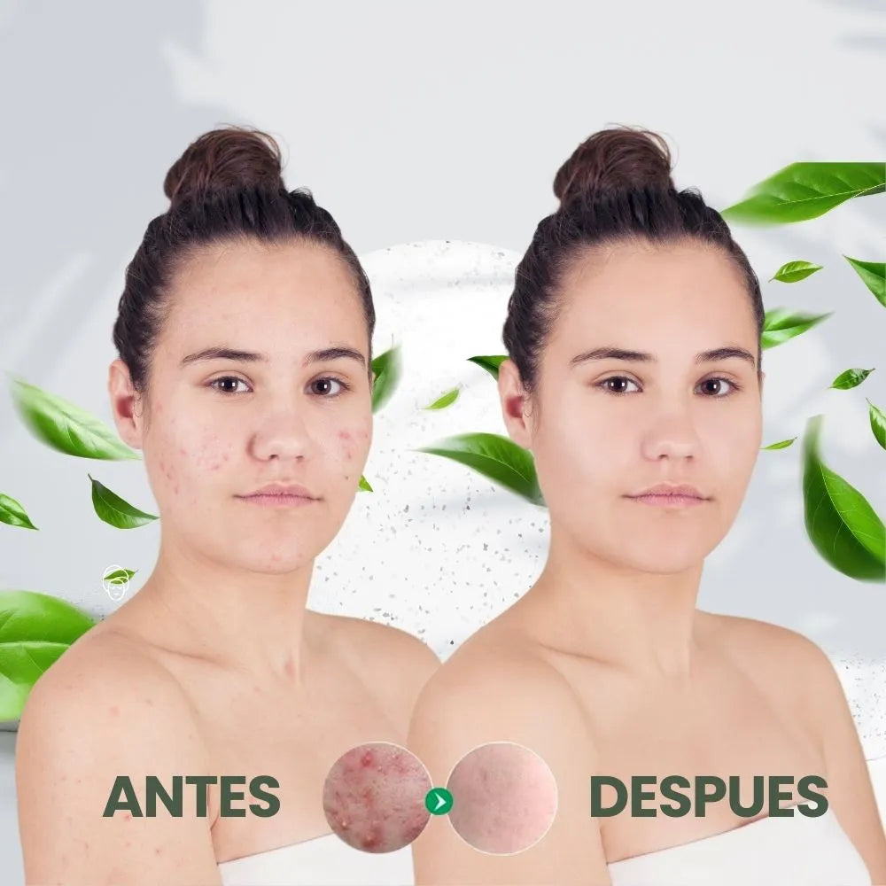 Serum Antiacné Ácido Salicílico de Sadoer - Piel fresca, sin imperfecciones.