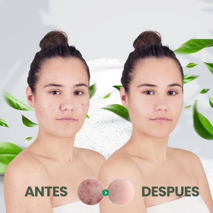 Serum Antiacné Ácido Salicílico de Sadoer - Piel fresca, sin imperfecciones.